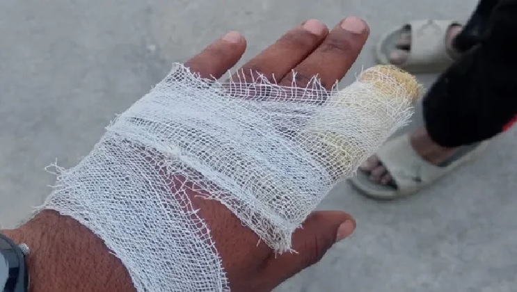 बच्चे के आम तोड़ने पर आगबबूला हुए ठेकेदार ने उसके चाचा की अंगुलियां चबा डालीं, मासूम को थप्पड़ भी मारे